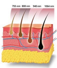 Sch&eacute;ma des types de peau et r&eacute;glages recommand&eacute;s pour appareil d&rsquo;&eacute;pilation laser diode 755-808-940-1064 nm &ndash; D&eacute;pil Beaut&eacute;-